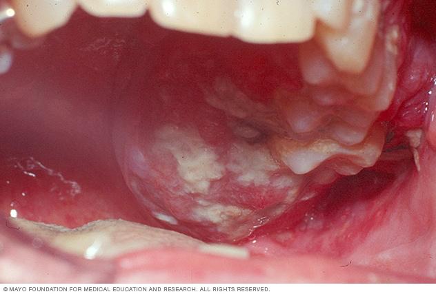 Oral Cancer: A Medical Insight into Mouth Tumors