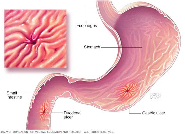 Gastric ulcers, which appear on the inside of the stomach.