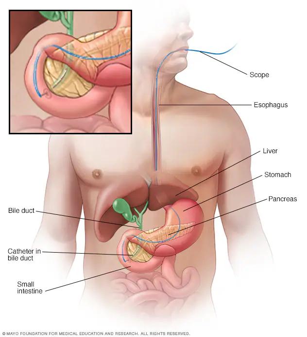 Pancreatic Cancer: What It Is and How It Affects the Body