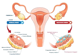 Polycystic Ovary Disorder