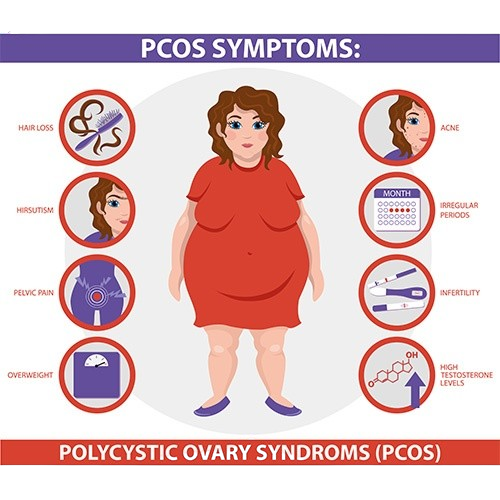 PCOS: Polycystic Ovary Syndrome