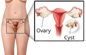 Ovary Cysts: Understanding the Condition
